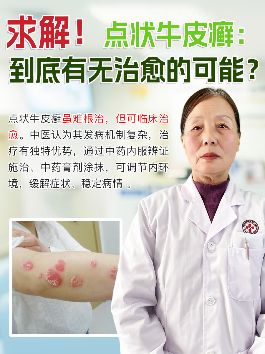 求解！点状牛皮癣：到底有无治愈的可能？
