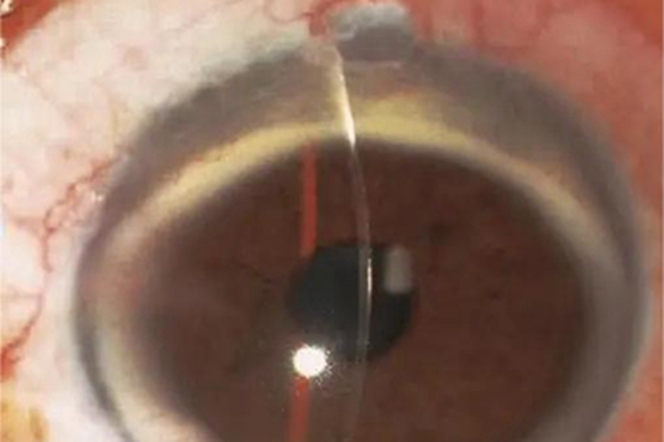 边缘性角膜变性角膜边缘浑浊图