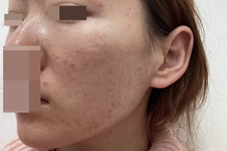 痤疮脸部红色丘疹图