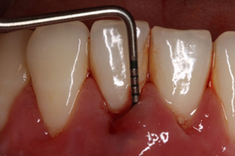 牙周脓肿牙龈肿块图