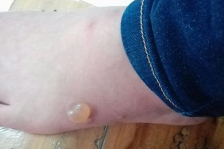 蜈蚣蜇伤症状图 蜈蚣蜇伤症状图