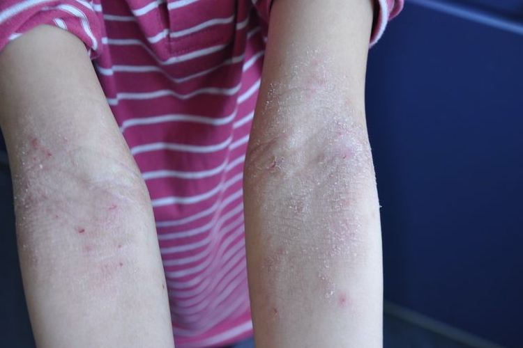 湿疹胳膊上起皮屑图