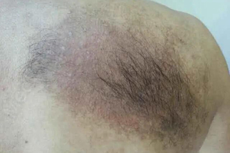 色素性毛表皮痣背部症状图