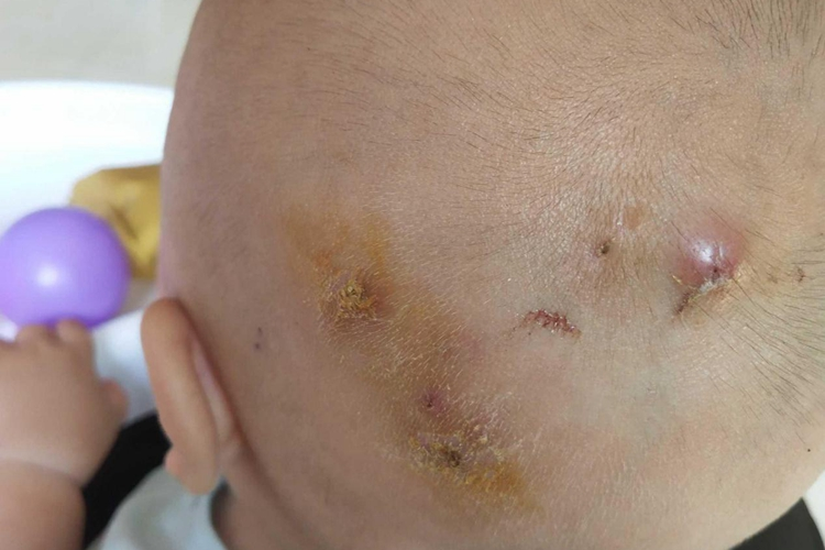 后脑右侧长疖图 后脑右侧长疖图