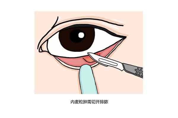 如何判断是不是针眼-有来医生