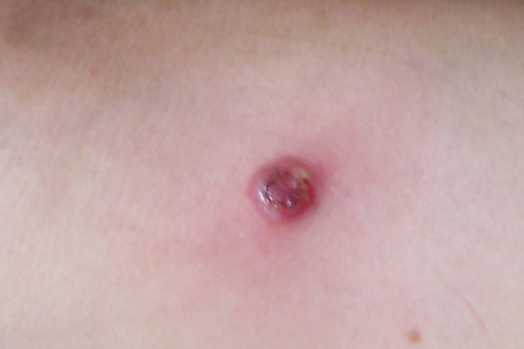 钱币状湿疹长疱疹图