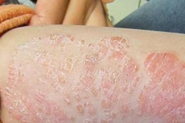 松皮癣胳膊皮肤增厚图