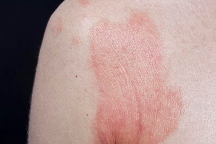 光毒性接触性皮炎肩部症状图 光毒性接触性皮炎肩部症状图