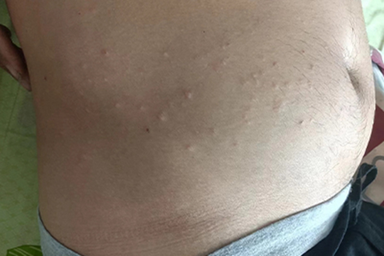 过敏性皮炎腹部长皮色疙瘩图
