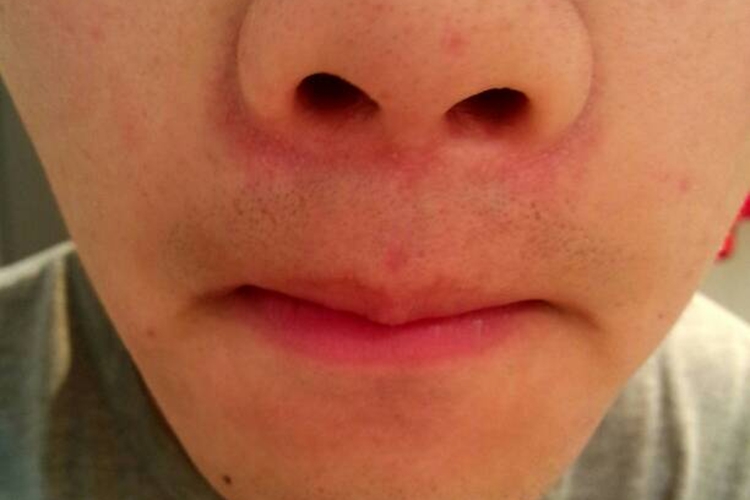 摩擦刺激鼻子下面发红图
