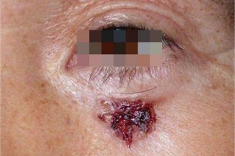 表浅型基底细胞瘤眼睑结痂图