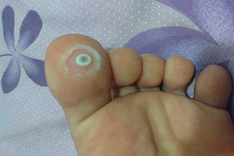 鸡眼图