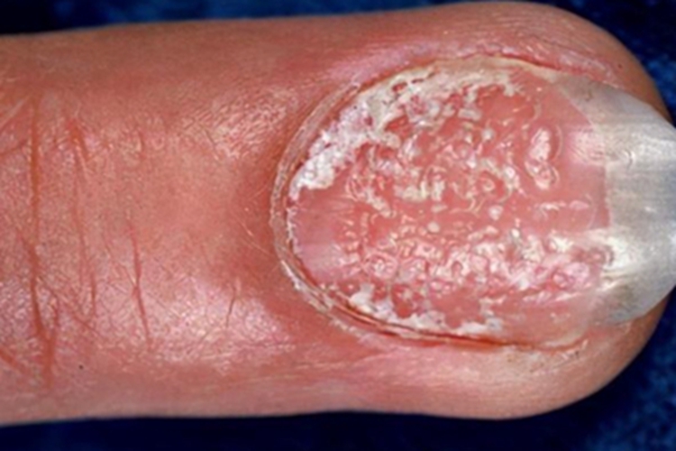 银屑病甲脱皮图