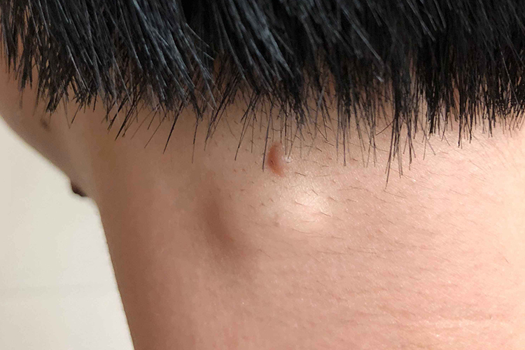 脖子后面皮脂腺囊肿图