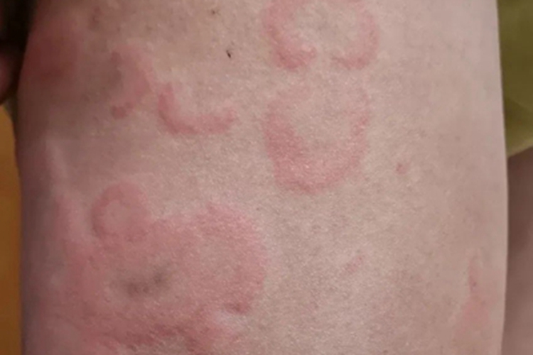 单纯性回状红斑小腿红斑图