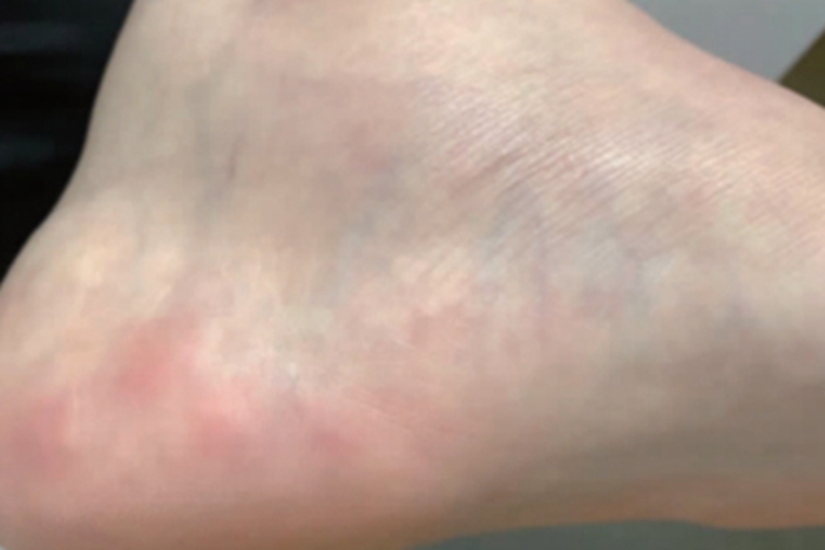 足跟压力性疼痛性丘疹小红疙瘩图 足跟压力性疼痛性丘疹小红疙瘩图