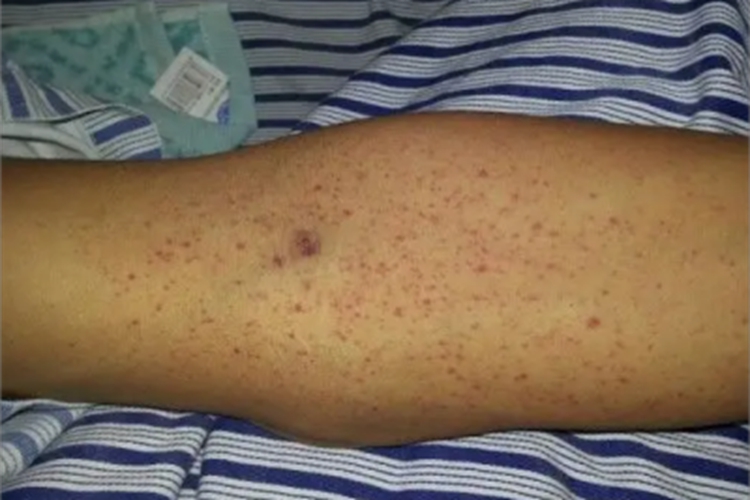 登革热胳膊红斑图