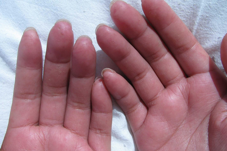 系统性硬化症萎缩期图