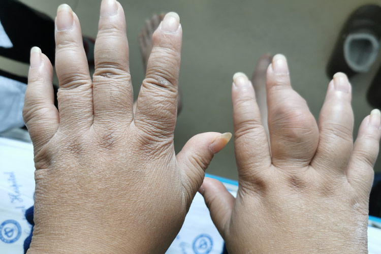 痛风初期关节肿胀图