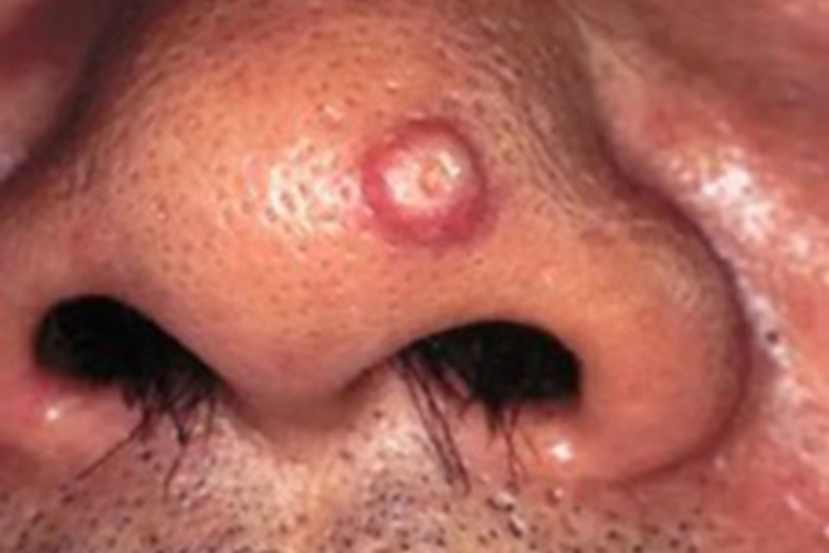 角化棘皮瘤鼻尖小疙瘩图 角化棘皮瘤鼻尖小疙瘩图