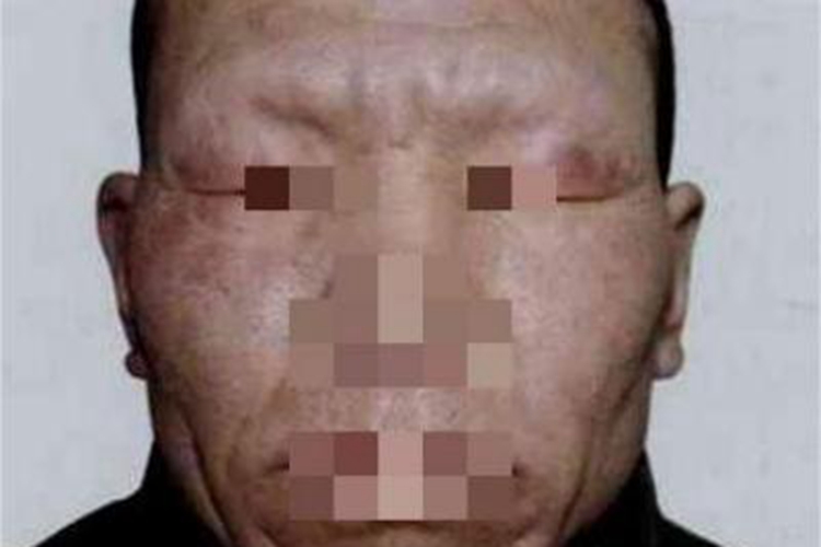 眼睑麻风眼周暗结图