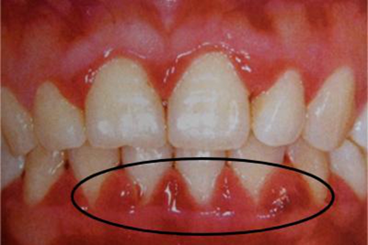 妊娠期龈炎牙龈症状图