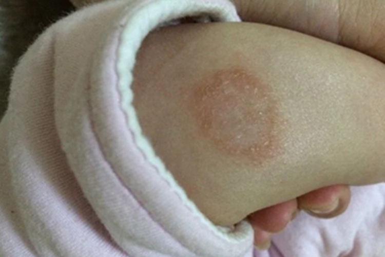 六个月宝宝起钱币状湿疹图 六个月宝宝起钱币状湿疹图