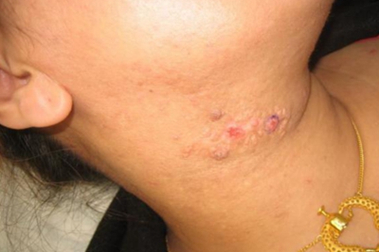 乳头状汗管囊腺瘤颈部丘疹图 乳头状汗管囊腺瘤颈部丘疹图