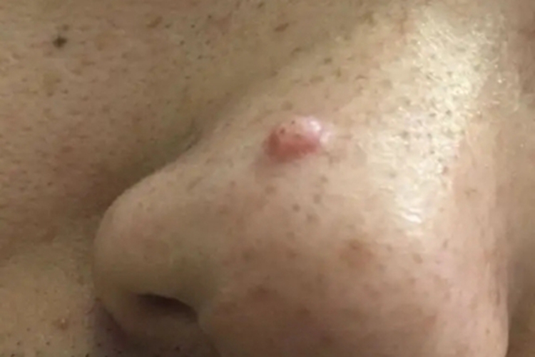 毛囊周围纤维瘤粉色疙瘩图