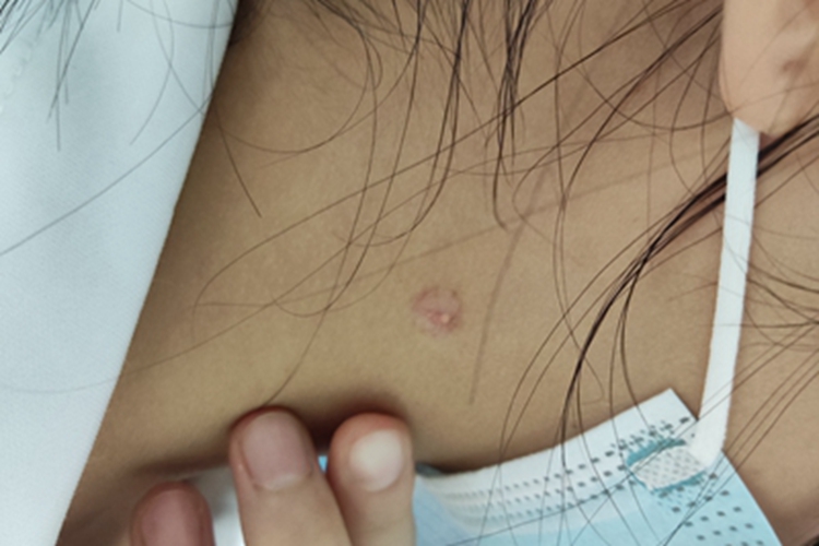 增生性瘢痕侧颈症状图 增生性瘢痕侧颈症状图