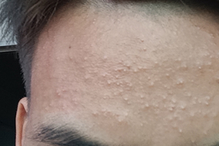 痱子症状图 痱子症状图