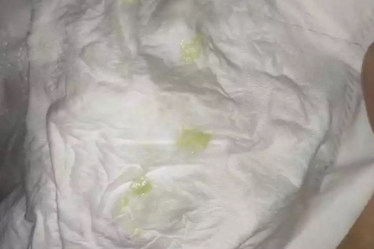 宫颈炎阴道分泌物发黄图 宫颈炎阴道分泌物发黄图