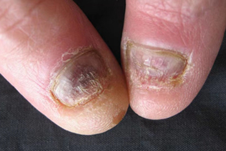 扁平苔藓手指甲缺损图 扁平苔藓手指甲缺损图