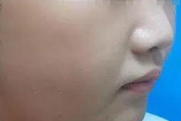 点阵激光后皮肤恢复正常图