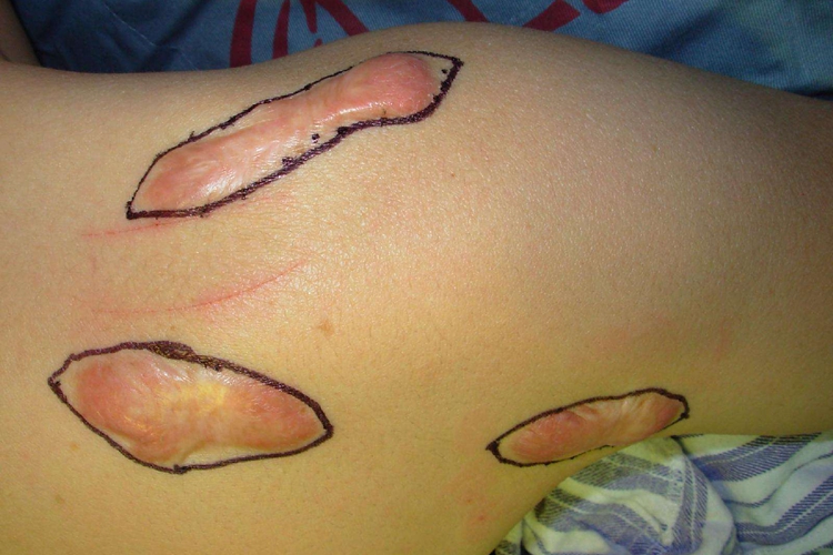 瘢痕疙瘩肩膀上有块瘢痕图