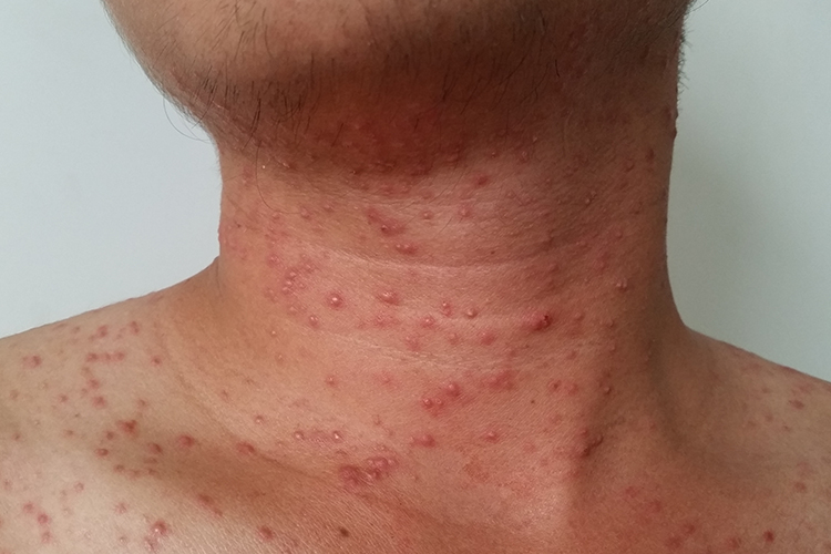 锁骨处马拉色菌毛囊炎图