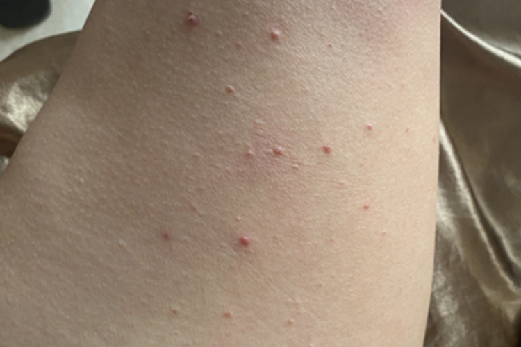 毛囊炎大腿丘疹图
