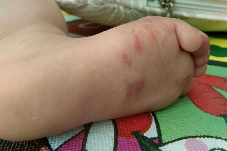 小孩脚底鲜红斑痣图