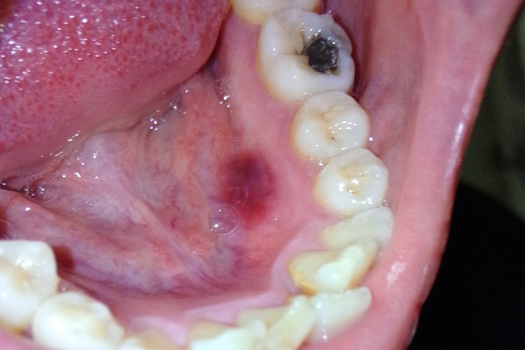 创伤性血疱破溃图 创伤性血疱破溃图
