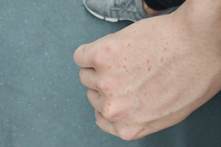 蚊虫叮咬手背出血点图