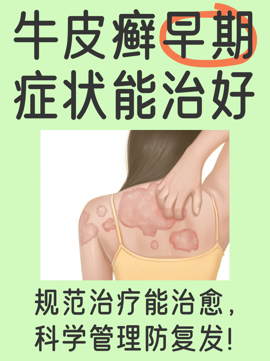 牛皮癣早期症状能治好吗?皮肤科医生说实话