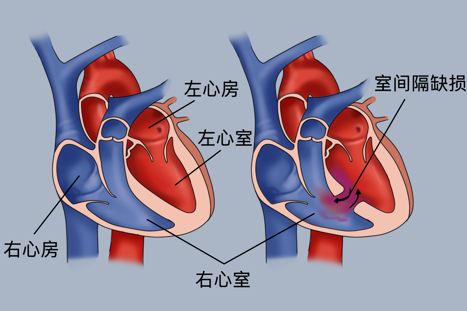 室间隔正常与缺损对比图