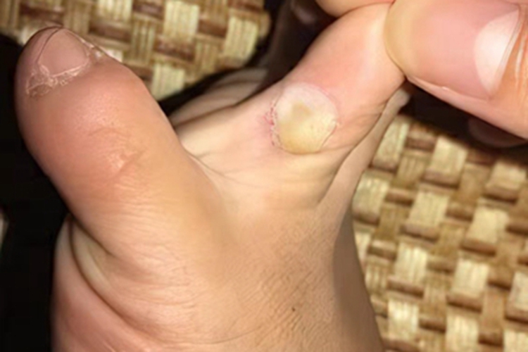 疣脚趾缝疙瘩图
