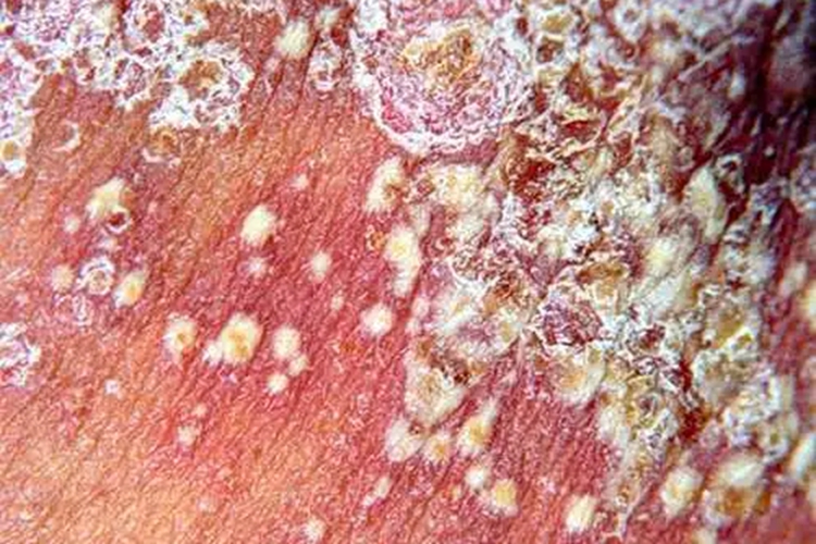 泛发性脓疱型银屑病晚期图