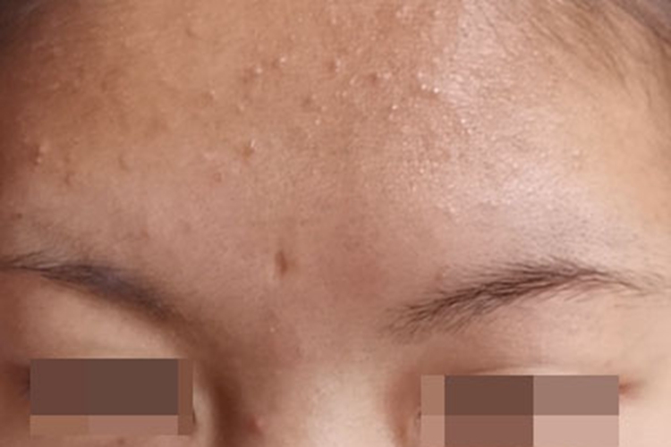 痤疮白头粉刺图