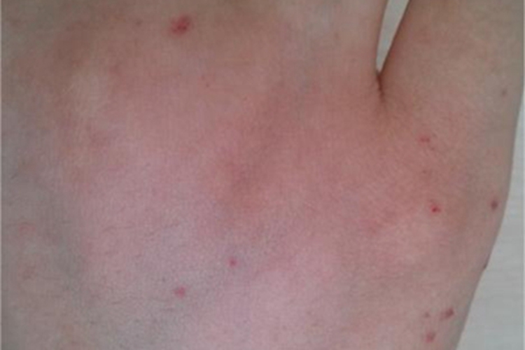 机械性紫癜手背症状图