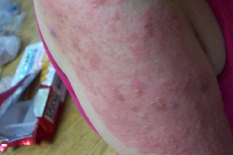 急性一氧化碳中毒胳膊红斑图 急性一氧化碳中毒胳膊红斑图