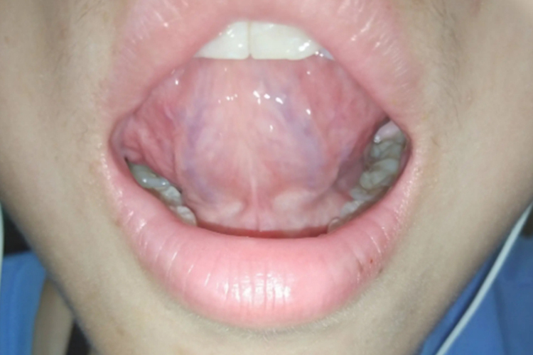 正常舌下肉阜图