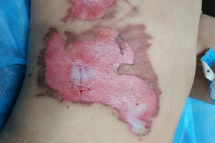 烫伤腹部症状图