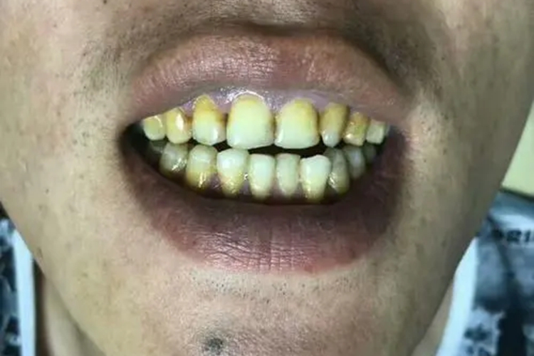 长期吸烟牙齿发黄图